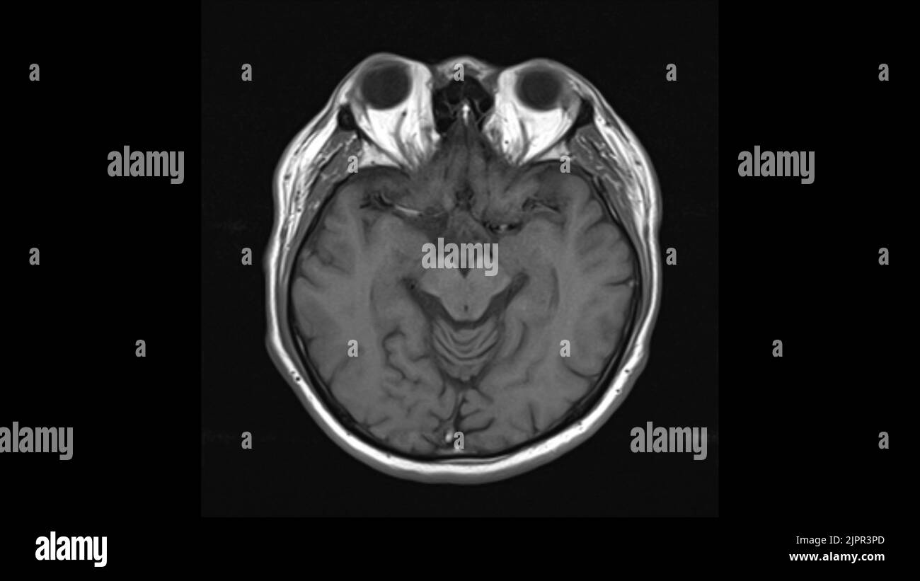 Cerveau en bonne santé, IRM Banque D'Images
