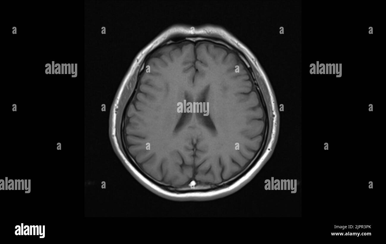 Cerveau en bonne santé, IRM Banque D'Images