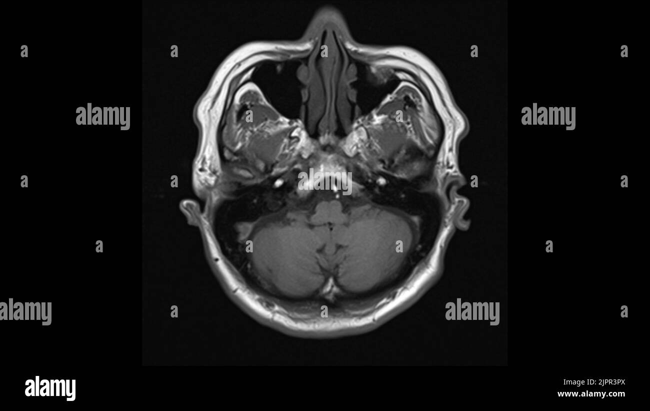 Cerveau en bonne santé, IRM Banque D'Images
