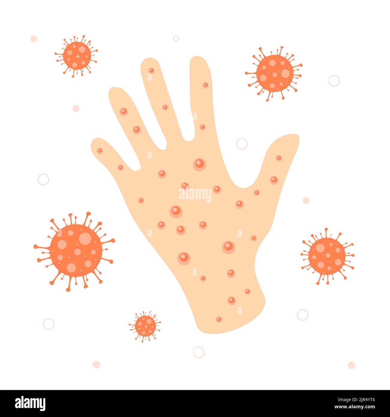 Acné sur la main de Monkeypox Illustration de Vecteur Acné sur la main de Monkeypox Illustration de Vecteur