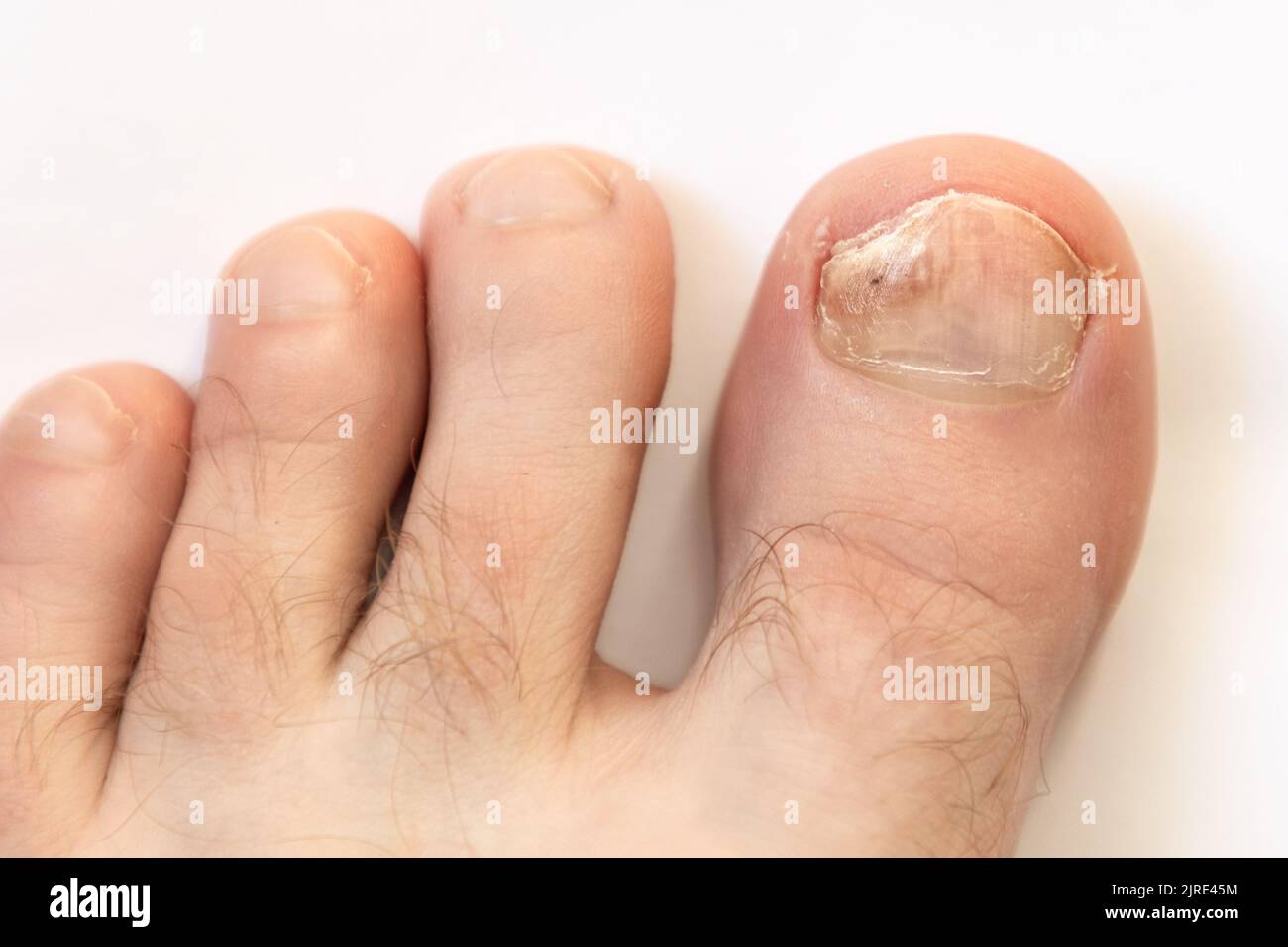 Le pied d'un homme avec un ongle endommagé endommagé par le champignon. Vue de dessus. Arrière-plan blanc. Le concept de pédiatrie et de chiropodie. Banque D'Images