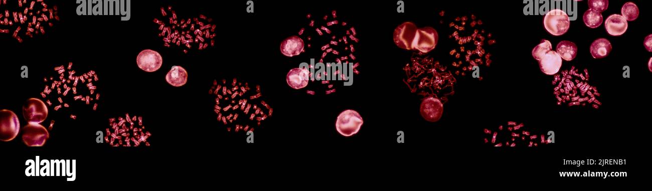 Chromosomes sous microscope à fluorescence, chromosomes humains de couleur rouge provenant du sang Banque D'Images