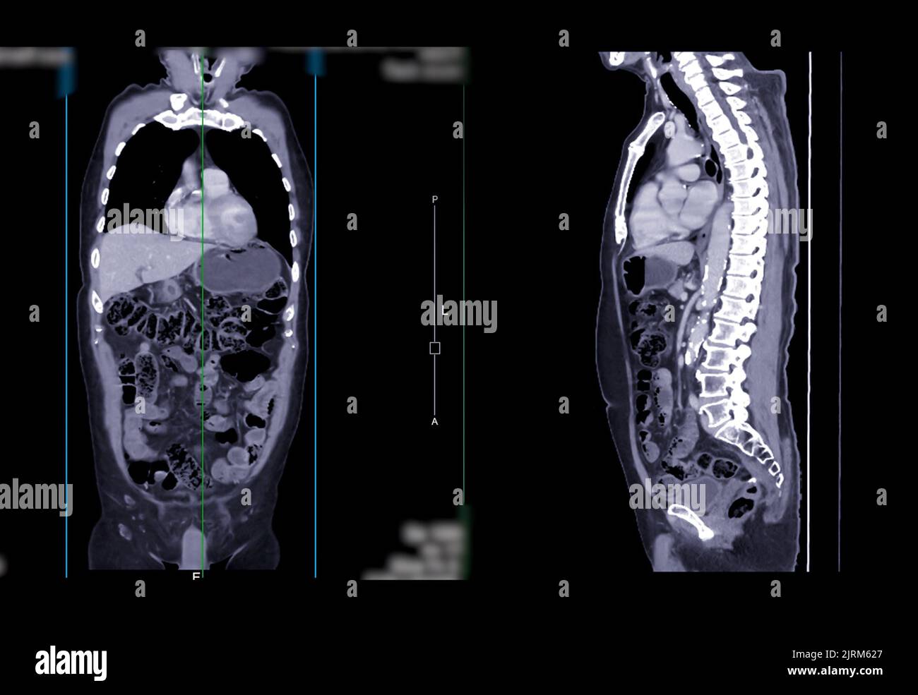 ACQUISITION CT du thorax et de l'abdomen vue coronale et sagittale avec produit de contraste par injection pour le diagnostic de la maladie du thorax et de l'abdomen. Banque D'Images