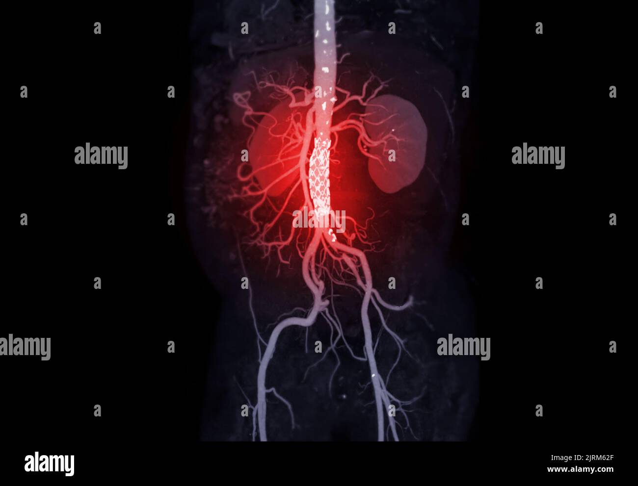 CTA de l'aorte abdominale avec endoprothèse dans l'anévrisme aortique abdominal du patient Photo