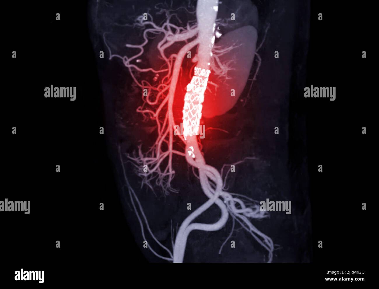 CTA de l'aorte abdominale avec endoprothèse dans l'anévrisme aortique abdominal du patient Photo