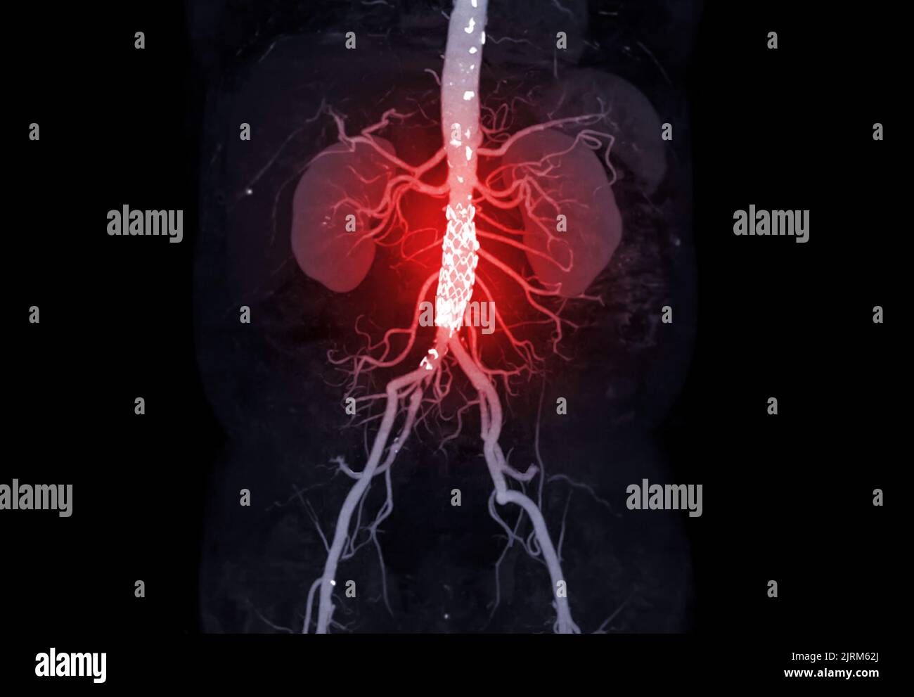 CTA de l'aorte abdominale avec endoprothèse dans l'anévrisme aortique abdominal du patient. Banque D'Images