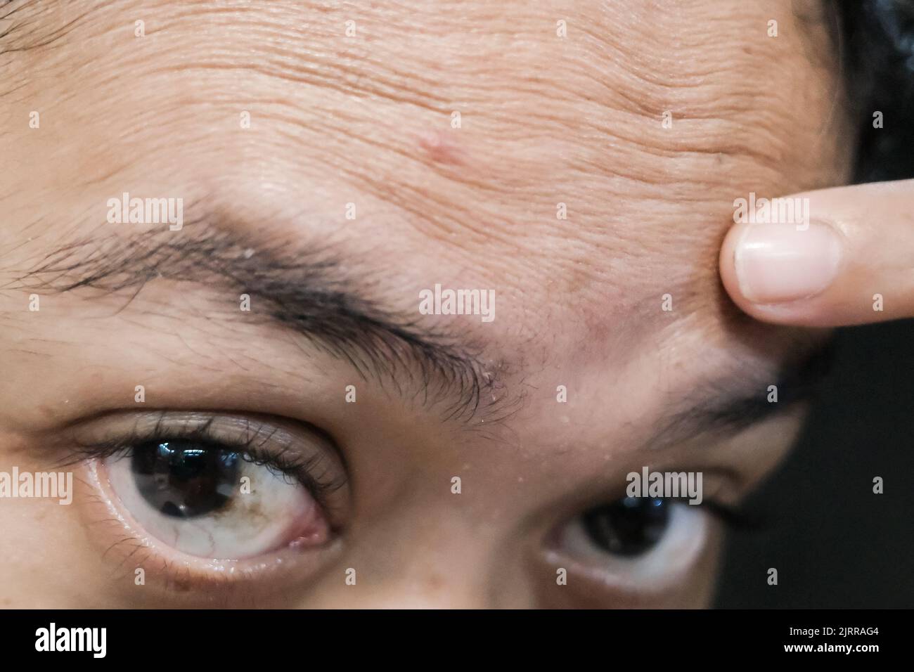 Une femme regardant sa peau de front sèche ridée non traitée sur Mirror Banque D'Images