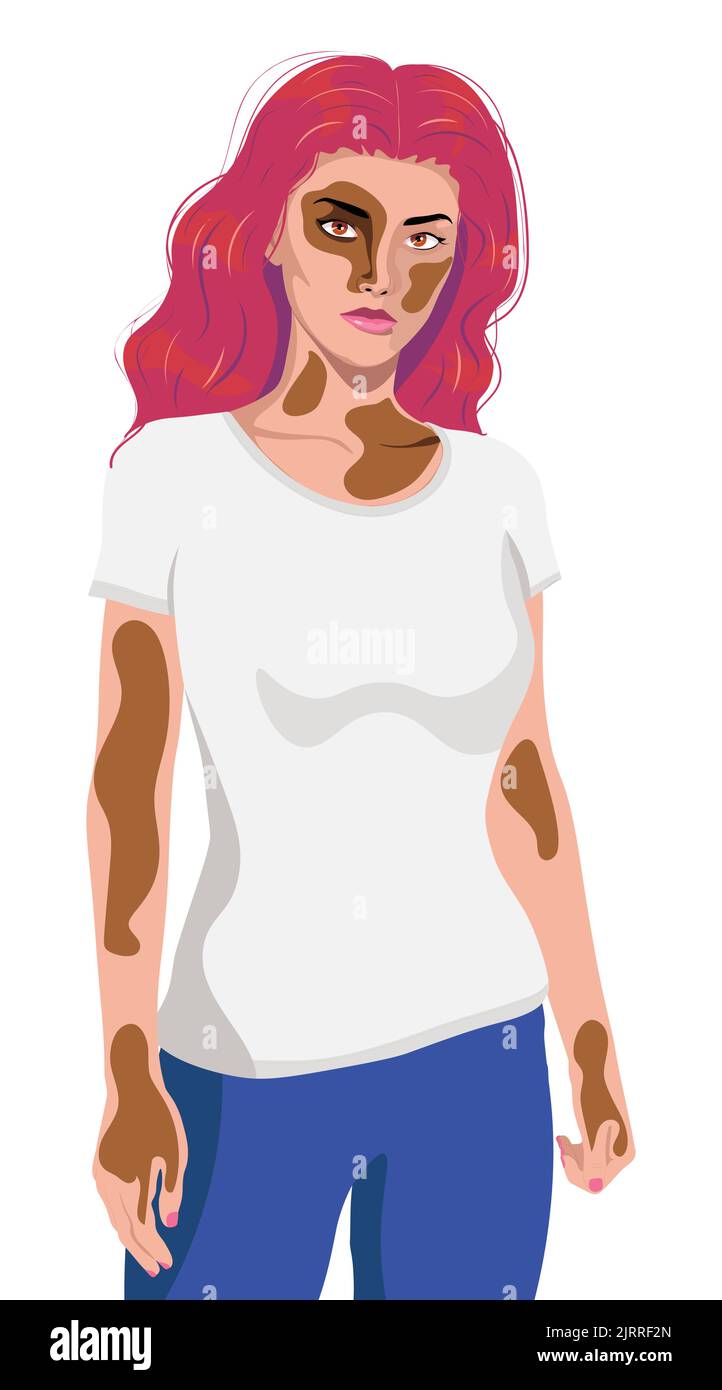 Une jeune femme avec vitiligo porte un t-shirt blanc et un pantalon bleu. Illustration de Vecteur