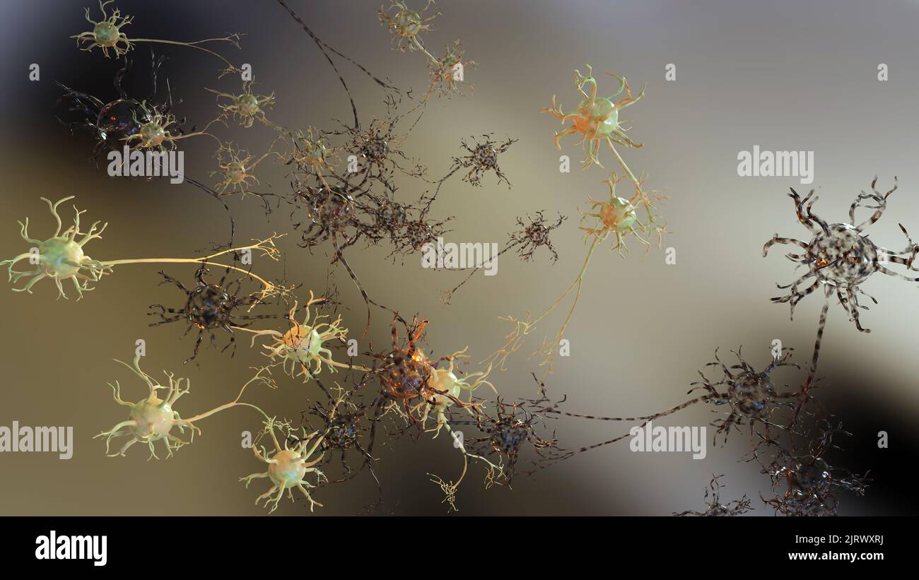 Lésion cérébrale traumatique légère, neurones endommagés, maladie d'alzheimers, lésion axonale diffuse, perturbation de la communication nerveuse, rendu 3D Banque D'Images