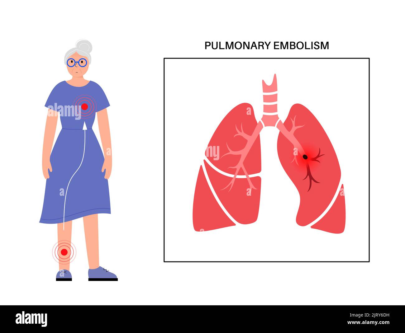 L'embolie pulmonaire, illustration Banque D'Images