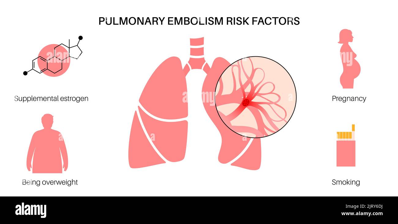 L'embolie pulmonaire, illustration Banque D'Images