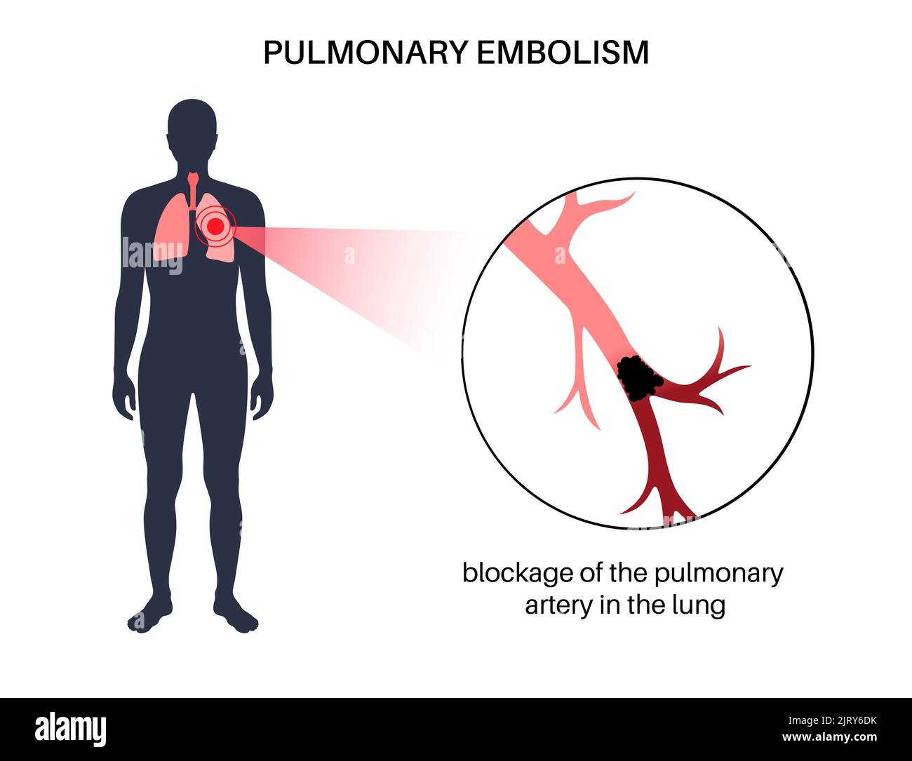 L'embolie pulmonaire, illustration Banque D'Images