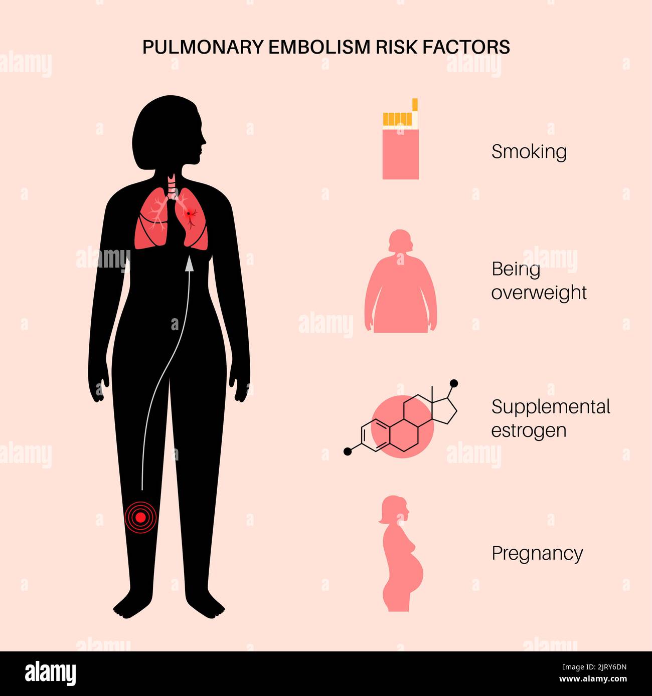 L'embolie pulmonaire, illustration Banque D'Images