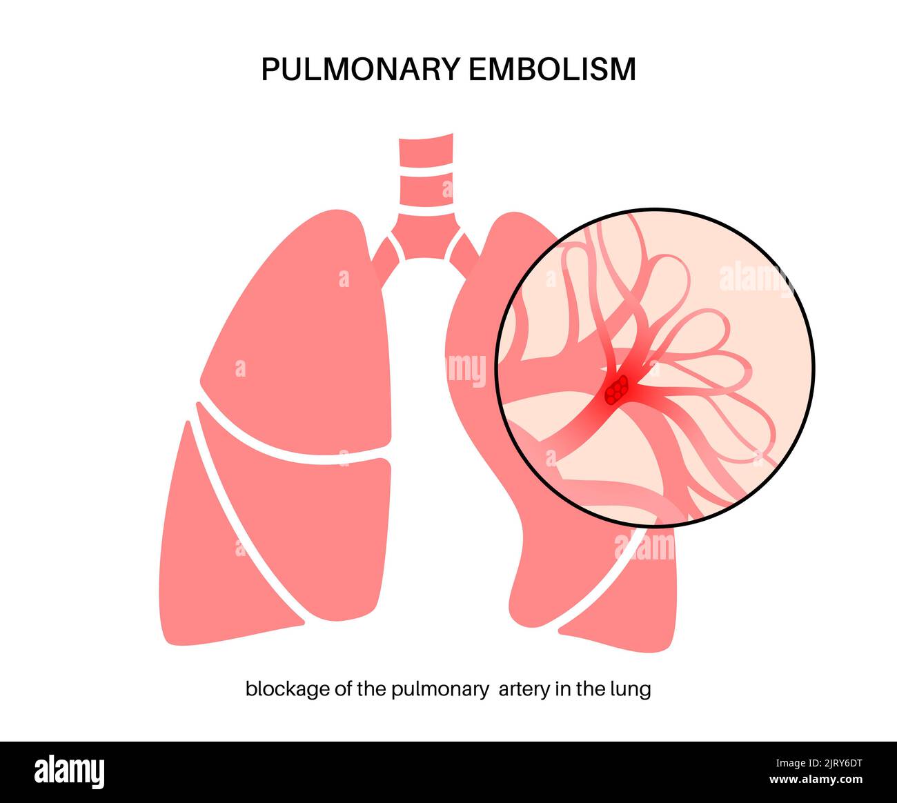 L'embolie pulmonaire, illustration Banque D'Images