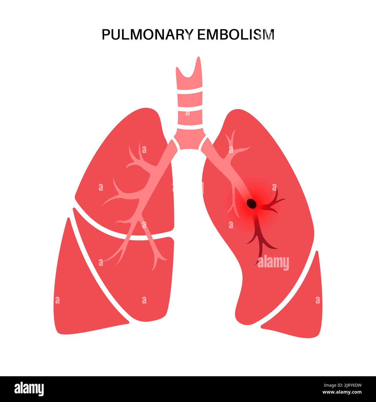 L'embolie pulmonaire, illustration Banque D'Images