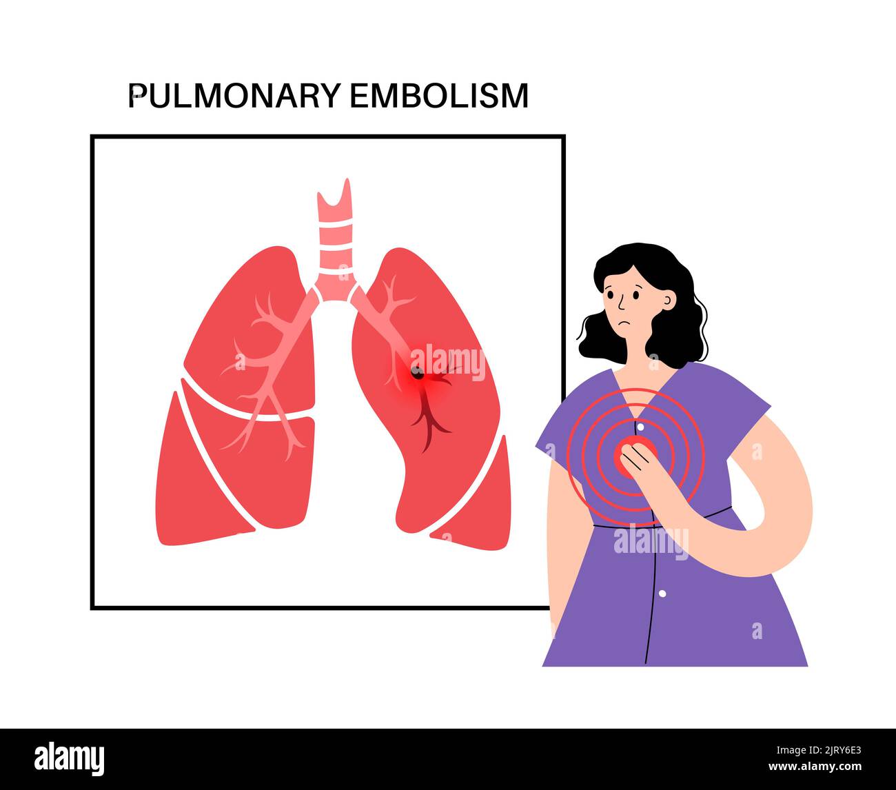 L'embolie pulmonaire, illustration Banque D'Images