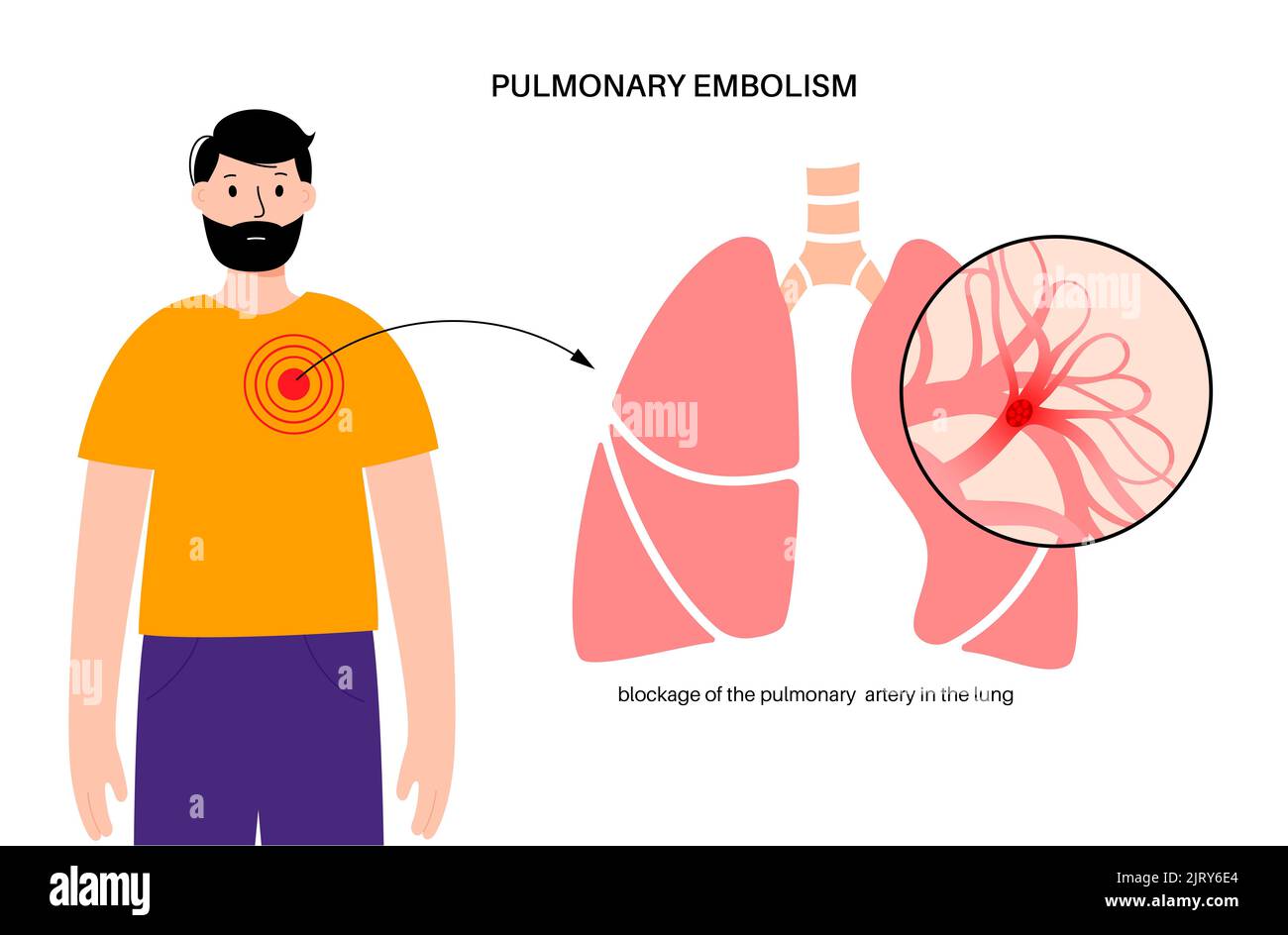 L'embolie pulmonaire, illustration Banque D'Images