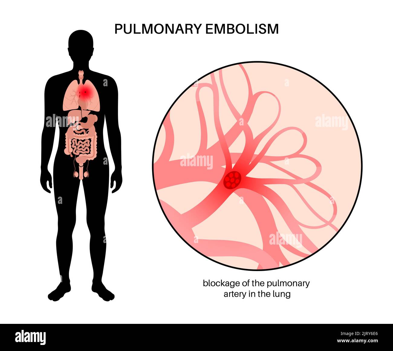 L'embolie pulmonaire, illustration Banque D'Images