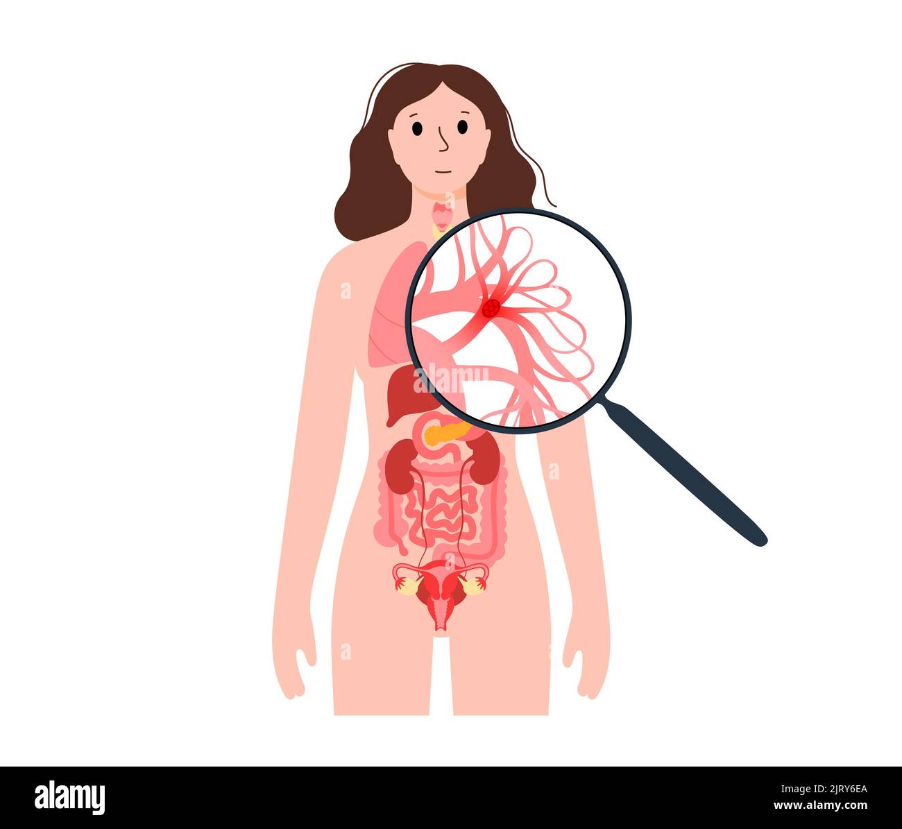 L'embolie pulmonaire, illustration Banque D'Images