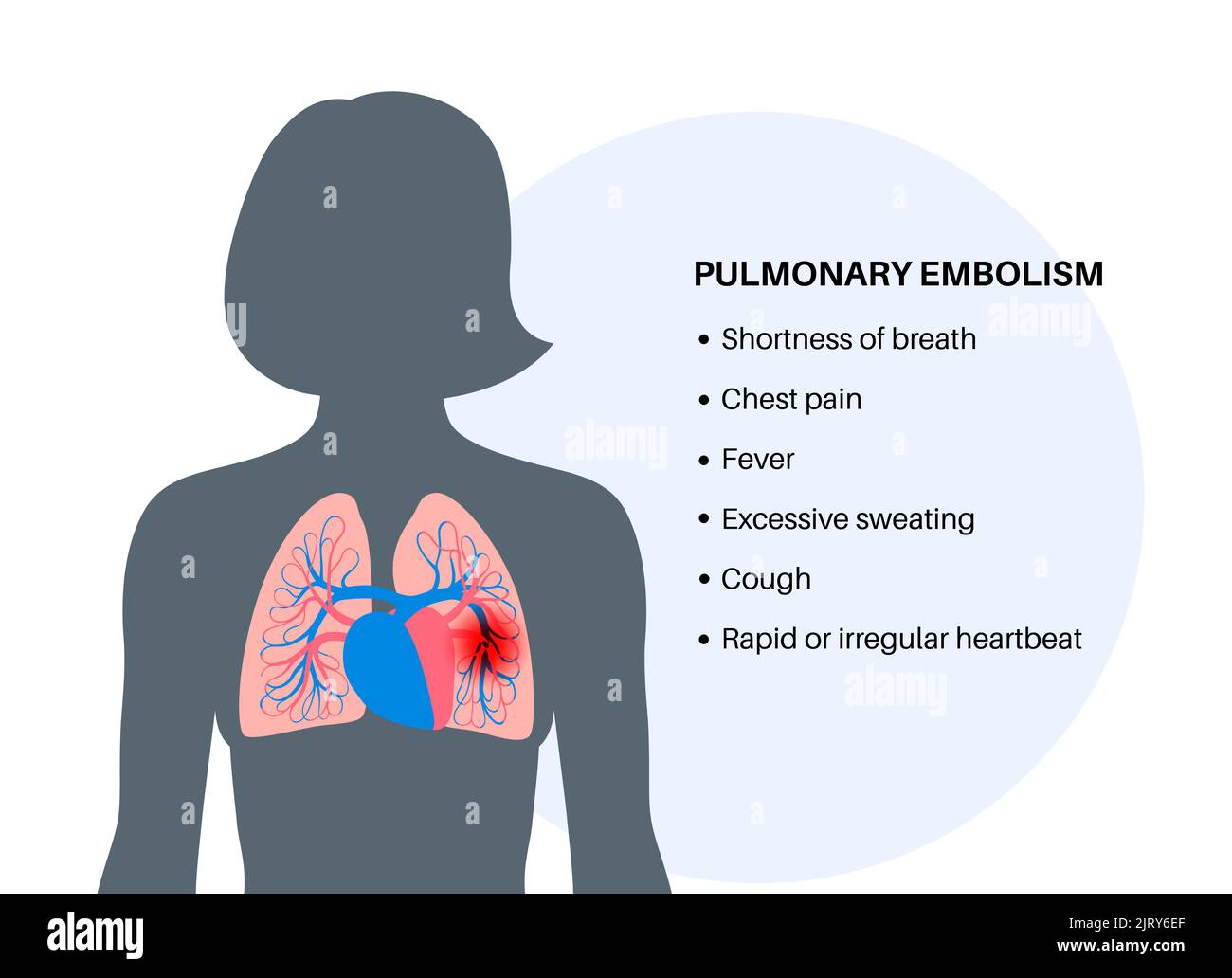L'embolie pulmonaire, illustration Banque D'Images