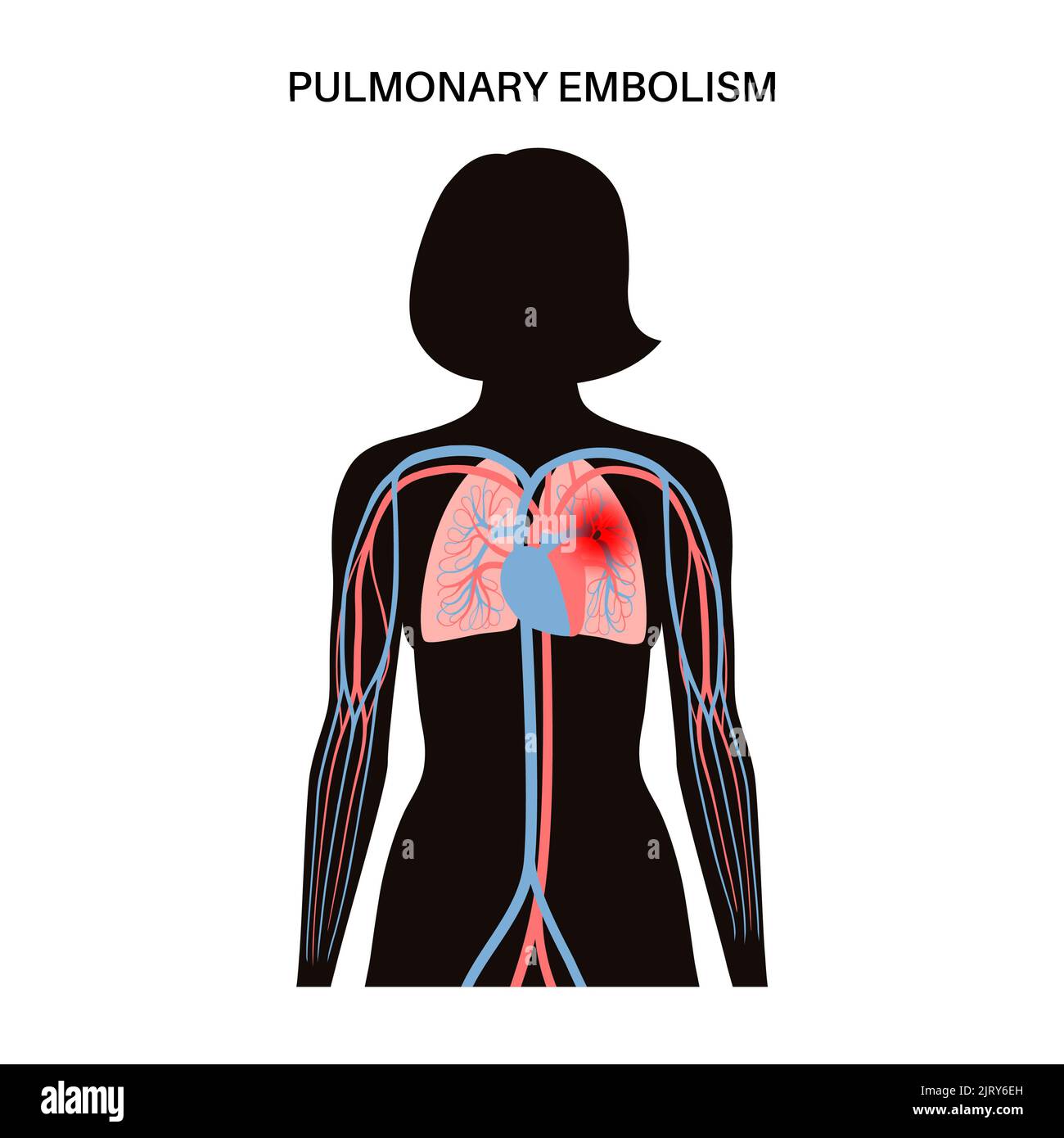 L'embolie pulmonaire, illustration Banque D'Images