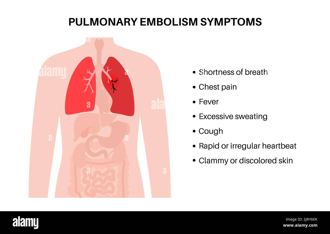 L'embolie pulmonaire, illustration Banque D'Images
