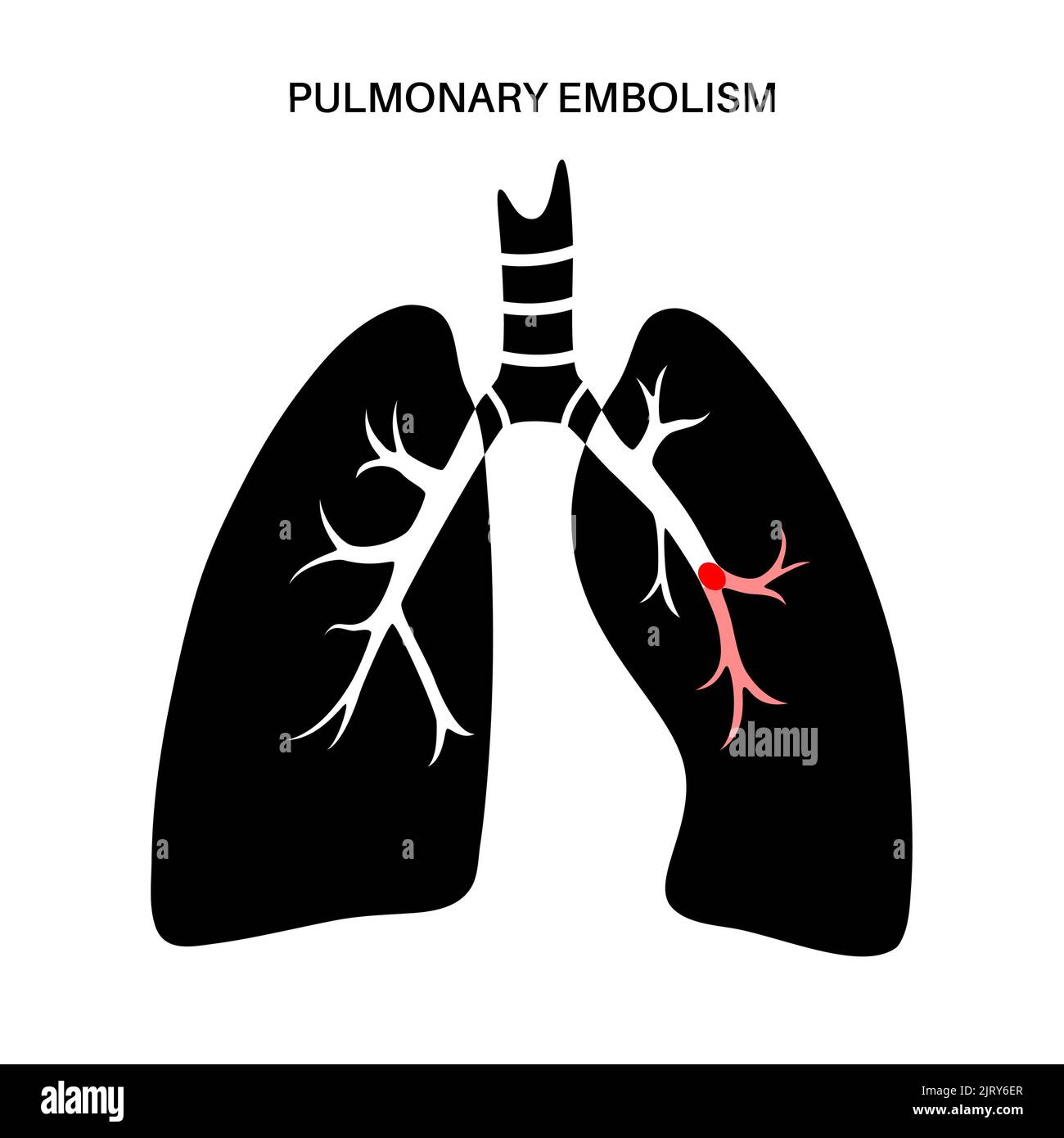 L'embolie pulmonaire, illustration Banque D'Images