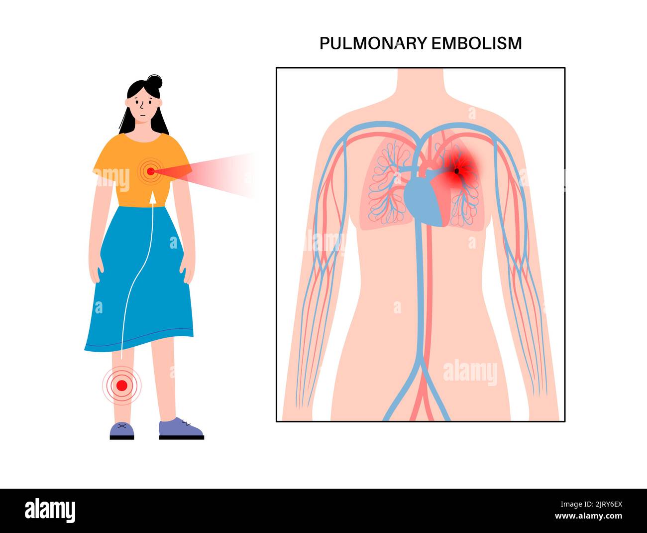 L'embolie pulmonaire, illustration Banque D'Images