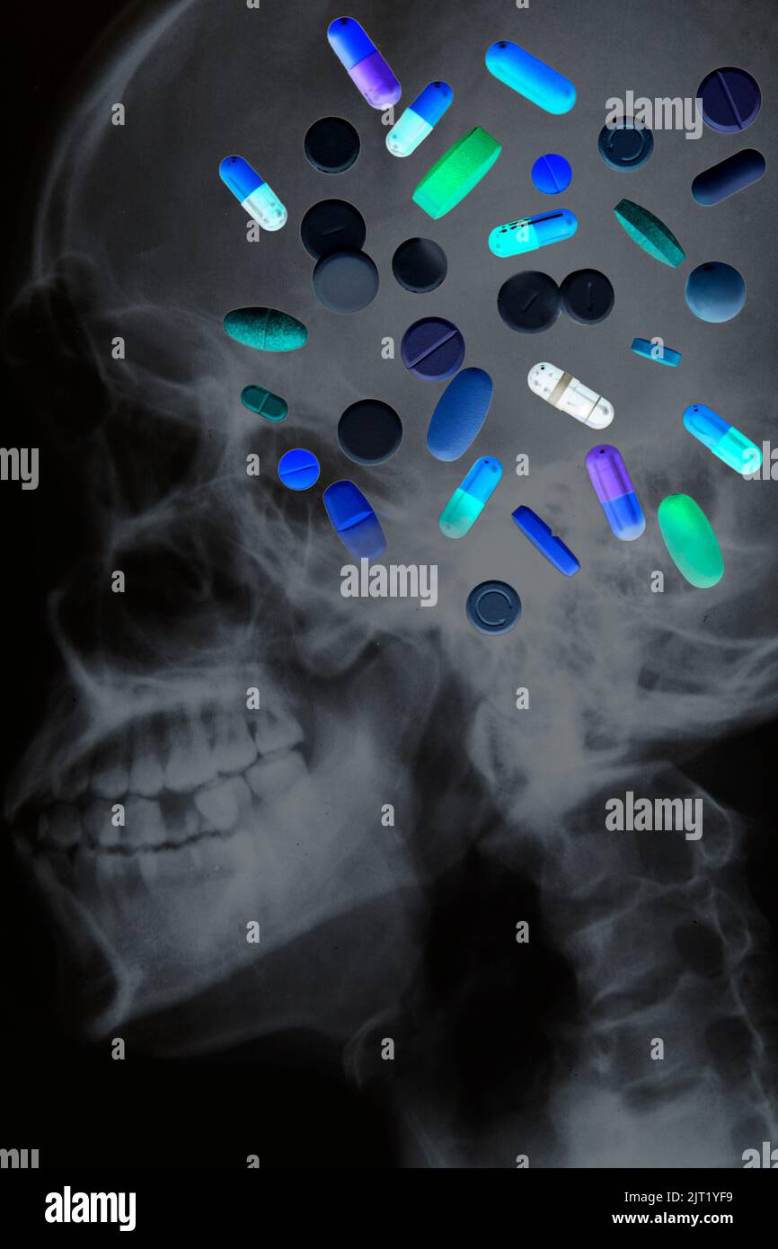 Une drogue colorée négative est dispersée sur le rayon X de la tête Banque D'Images