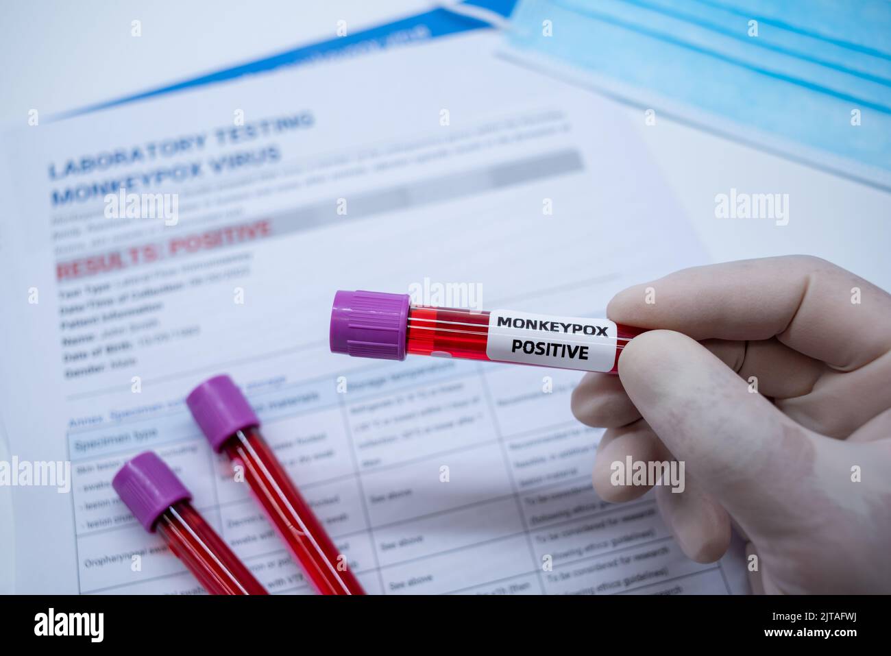 Les tubes de prélèvement sanguin et la fiche technique sur les résultats positifs des tests de la variole du singe en laboratoire Banque D'Images