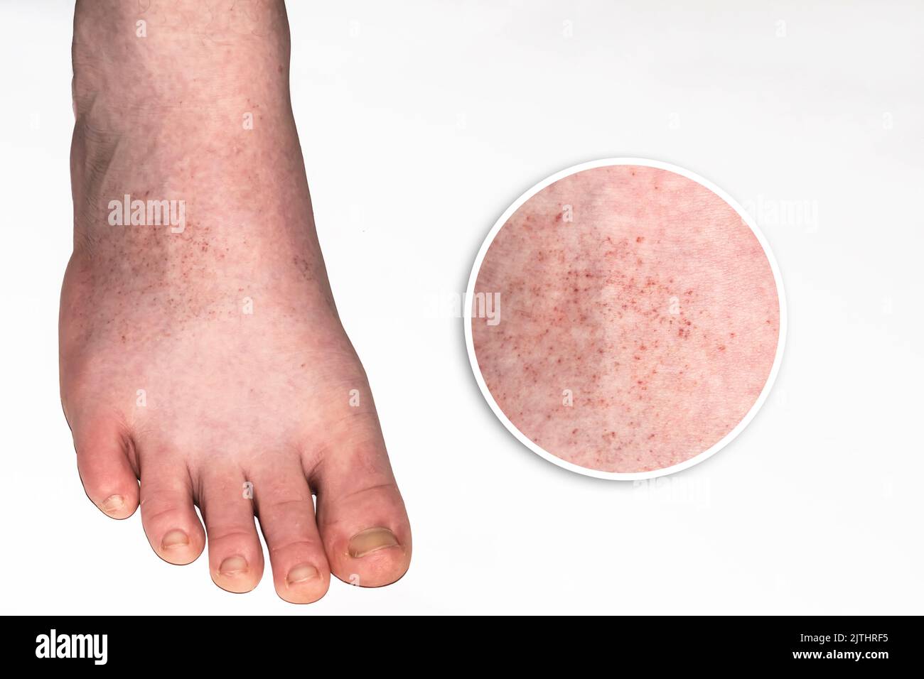 éruptions cutanées aux jambes Banque de photographies et d’images à haute résolution Alamy