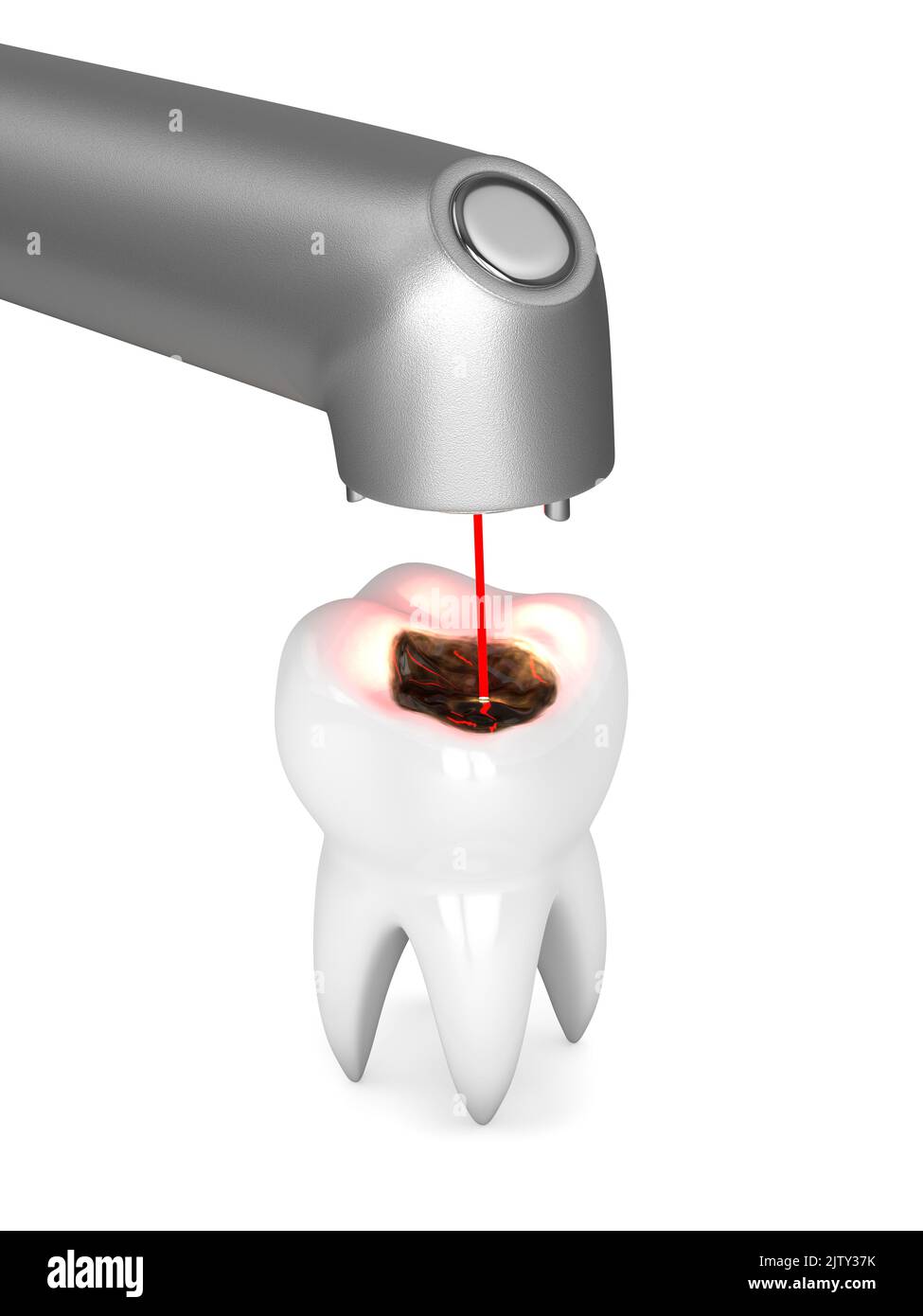 3d rendu de l'élimination de la carie dentaire avec laser dentaire. Nettoyage des dents sans douleur sans foret dentaire concept Banque D'Images