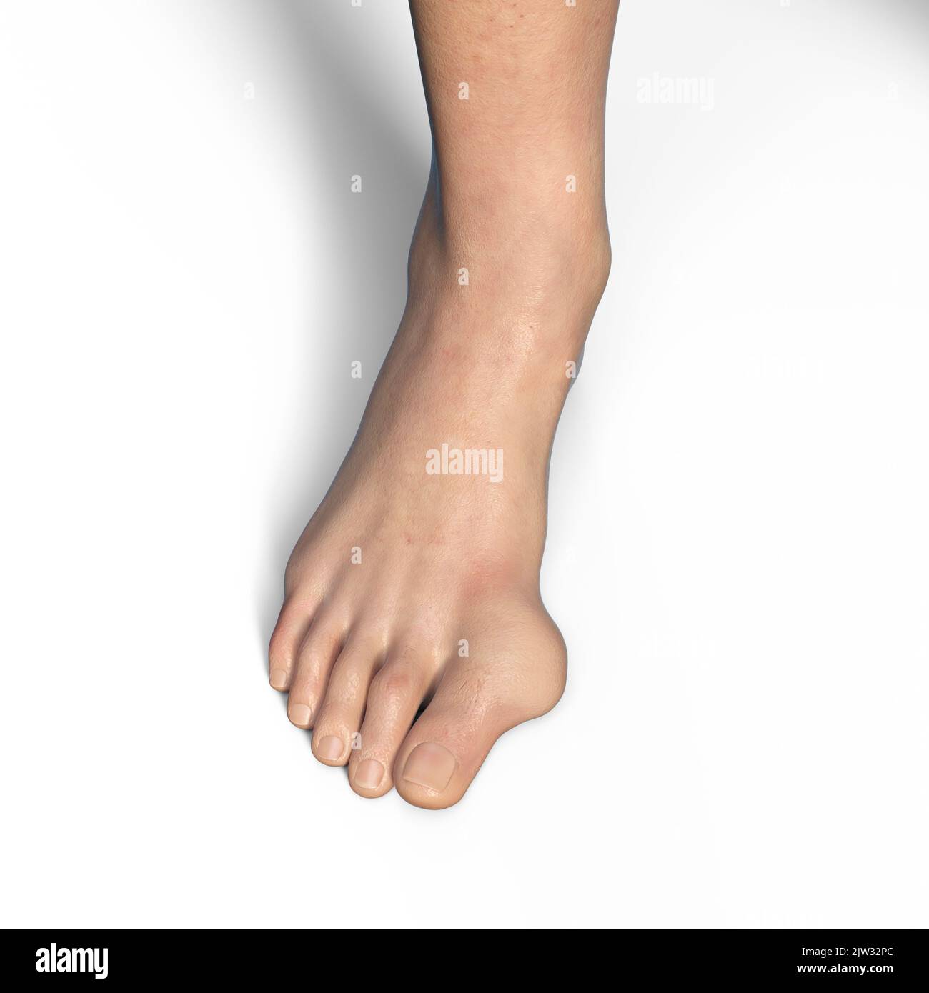 Hallux valgus, illustration. Un hallux valgus, ou Boignon, est une déviation anormale du gros orteil, qui conduit à une déformation à l'avant du pied au premier métatarsien du gros orteil. Banque D'Images