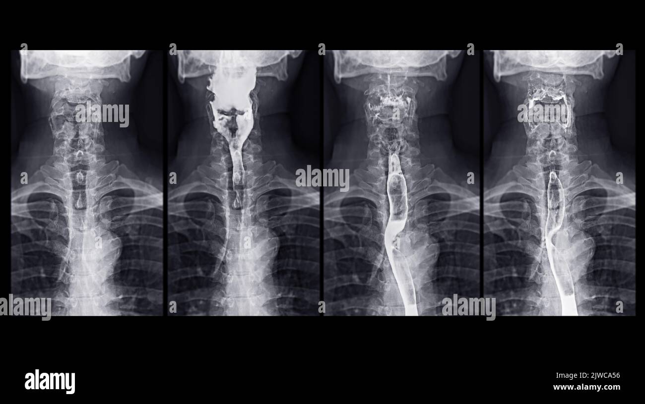 Examen de l'étude de baryum Swallow diagnostic de Barrett examen du tractus gastro-intestinal GERD série ulcères difficulté procédure pharynx UGI gorge traitement de l'intestin par fluoroscopie dev Banque D'Images