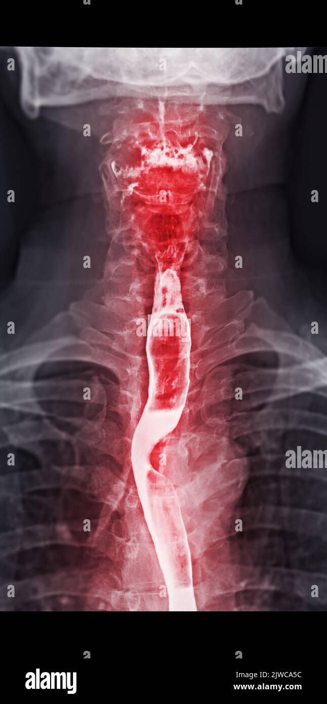 Examen de l'étude de baryum Swallow diagnostic de Barrett examen du tractus gastro-intestinal GERD série ulcères difficulté procédure pharynx UGI gorge traitement de l'intestin par fluoroscopie dev Banque D'Images
