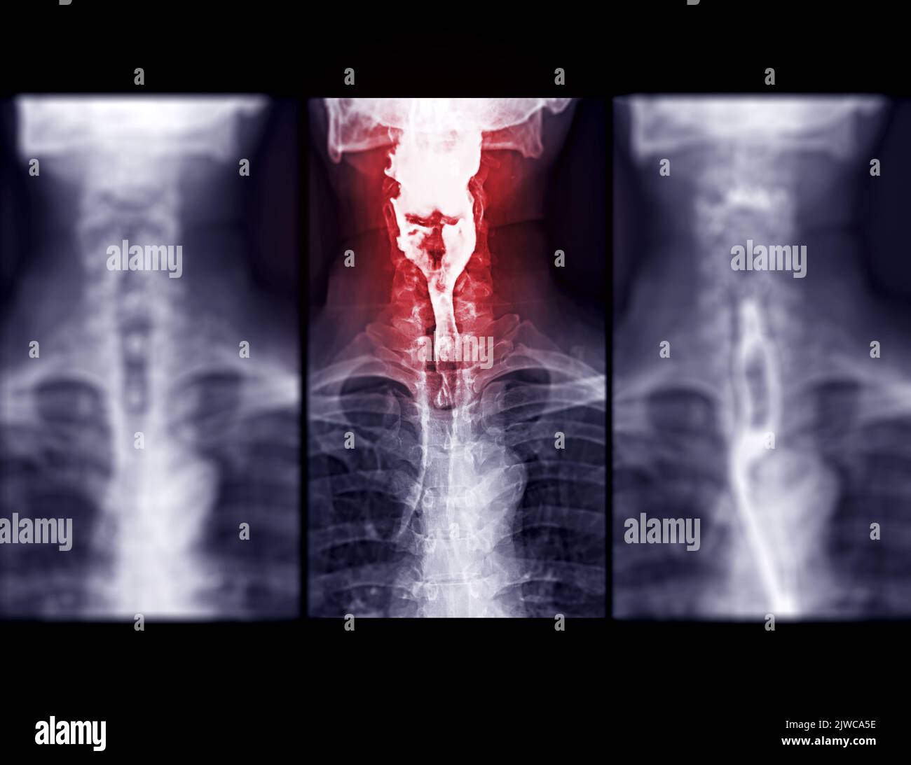 Examen de l'étude de baryum Swallow diagnostic de Barrett examen du tractus gastro-intestinal GERD série ulcères difficulté procédure pharynx UGI gorge traitement de l'intestin par fluoroscopie dev Banque D'Images