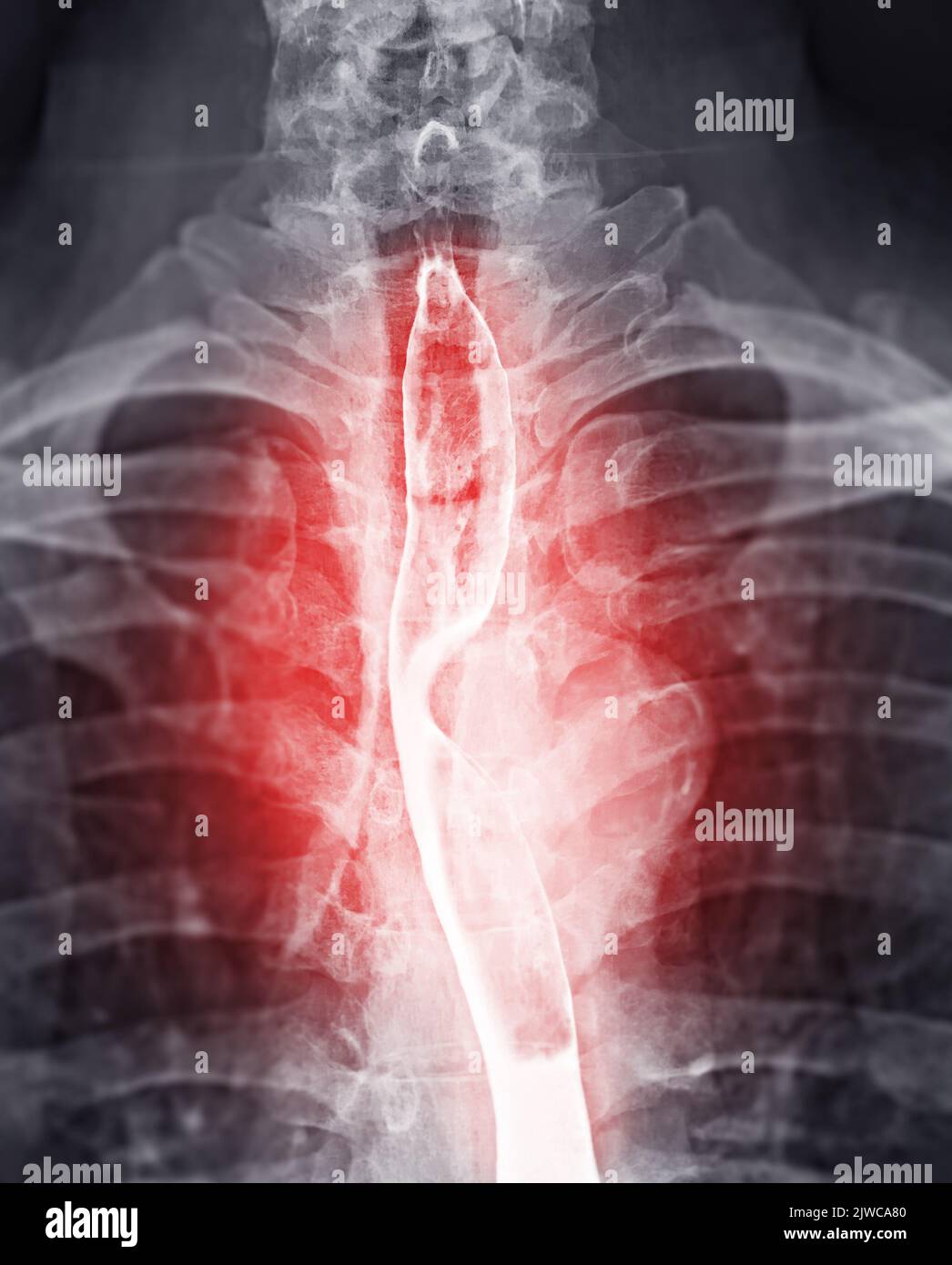 Examen de l'étude de baryum Swallow diagnostic de Barrett examen du tractus gastro-intestinal GERD série ulcères difficulté procédure pharynx UGI gorge traitement de l'intestin par fluoroscopie dev Banque D'Images