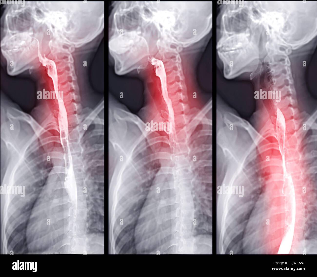 Examen de l'étude de baryum Swallow diagnostic de Barrett examen du tractus gastro-intestinal GERD série ulcères difficulté procédure pharynx UGI gorge traitement de l'intestin par fluoroscopie dev Banque D'Images