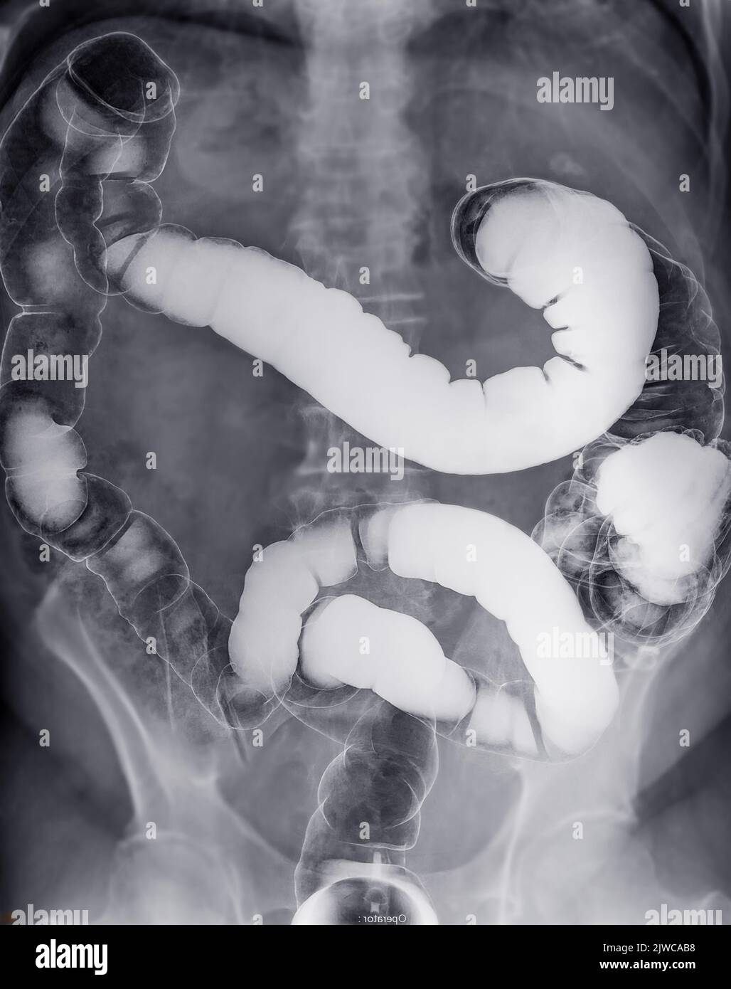 L'enema de baryum ou L'ÊTRE est l'image d'un gros intestin après l'injection d'un remplissage de contraste de baryum dans le côlon sous contrôle fluoroscopique isolé sur fond blanc Banque D'Images