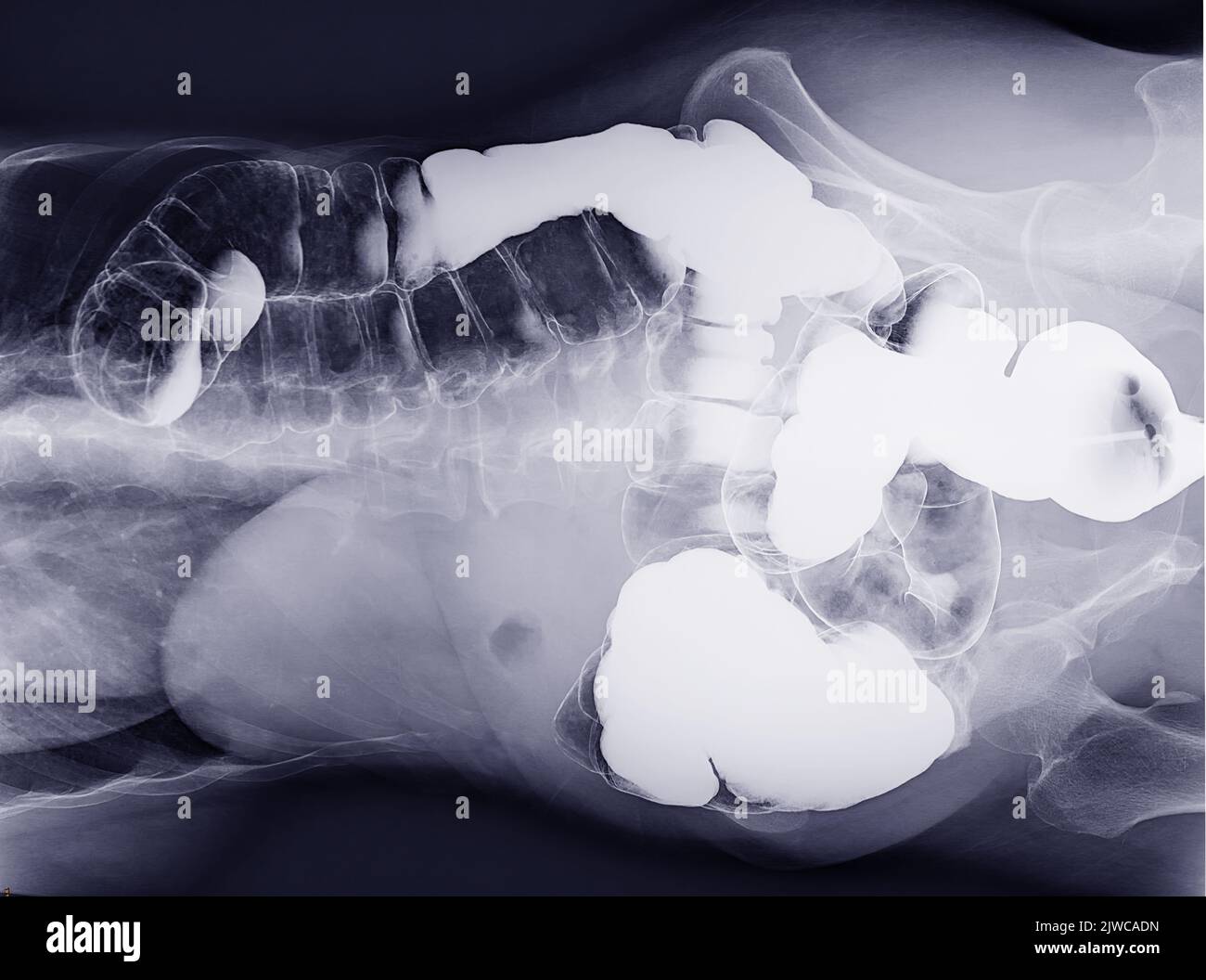 L'enema de baryum ou L'ÊTRE est l'image d'un gros intestin après l'injection d'un remplissage de contraste de baryum dans le côlon sous contrôle fluoroscopique isolé sur fond blanc Banque D'Images