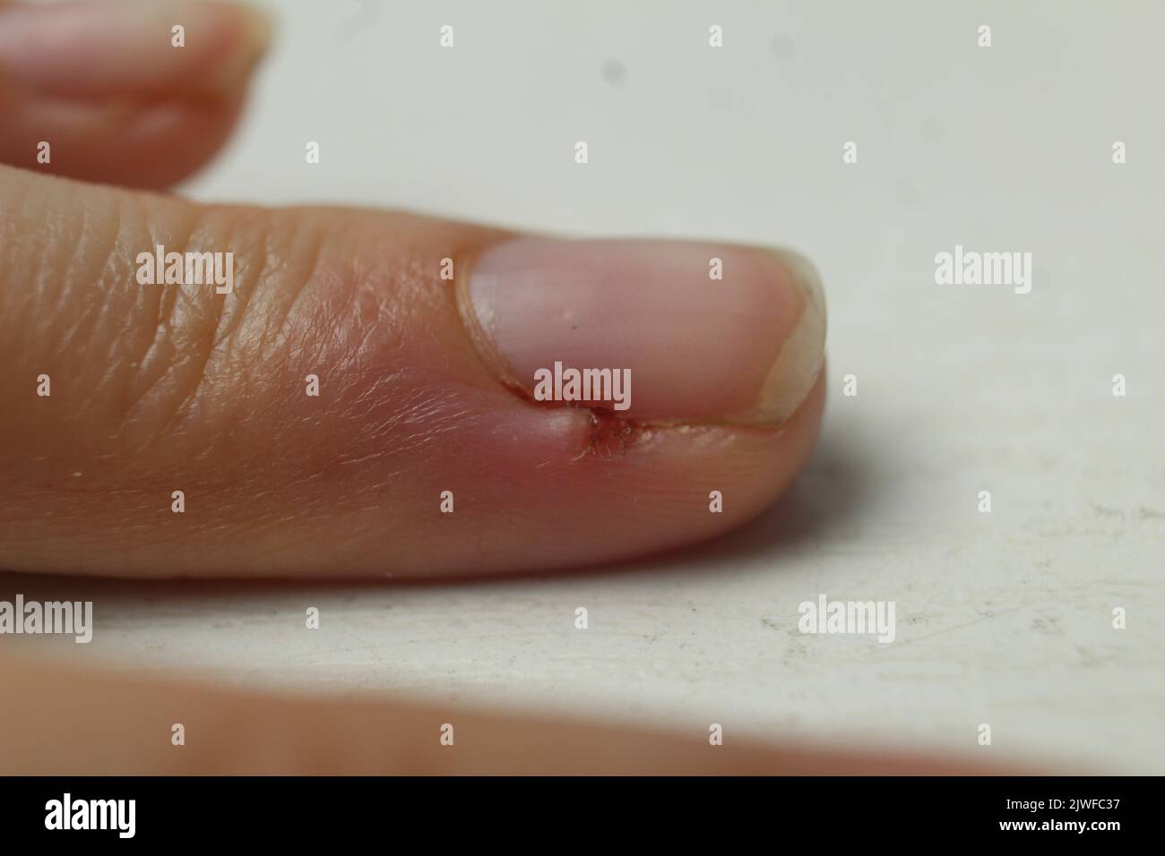 Bavure endommagée sur le doigt de la main. L'inflammation est une maladie du doigt. Autosoins. La plaie sur le doigt. Banque D'Images