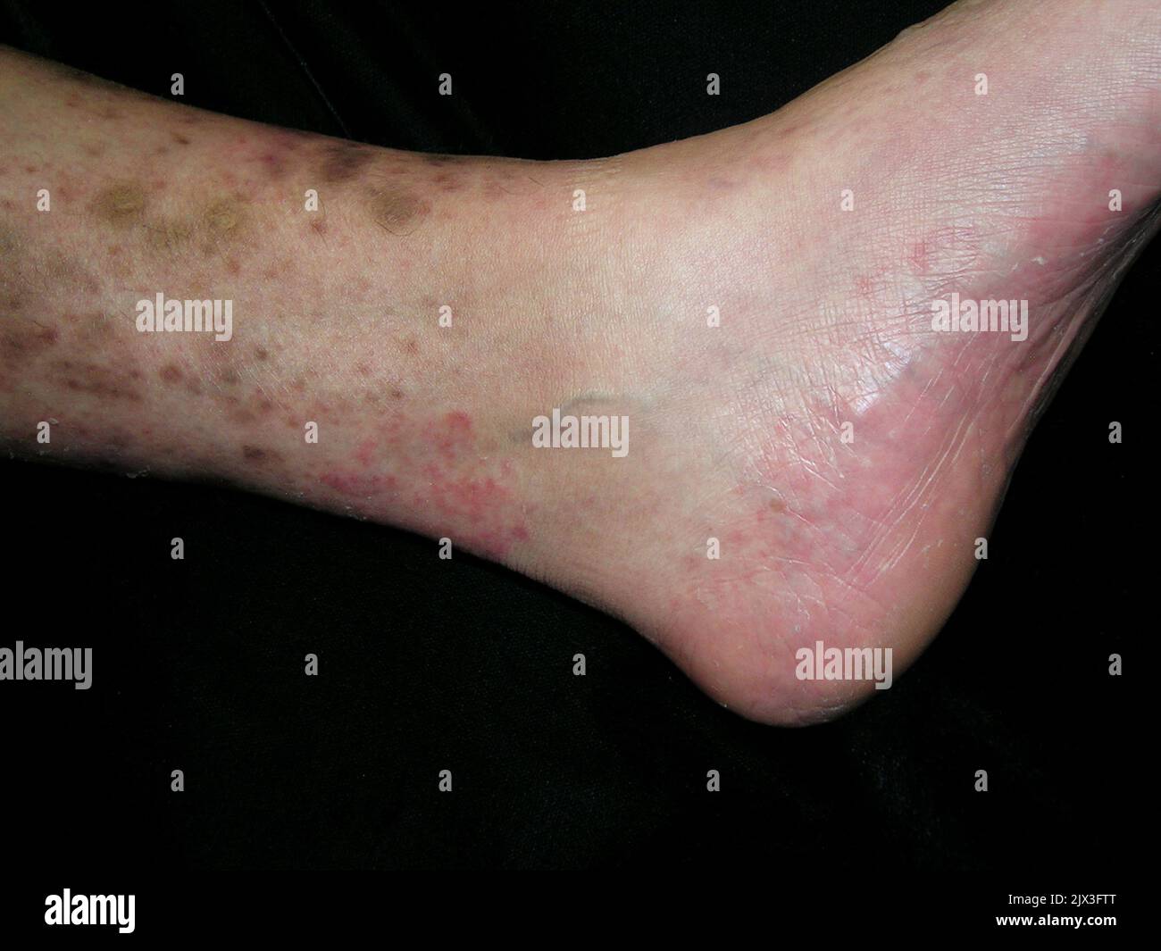 Éruption cutanée sur la jambe d