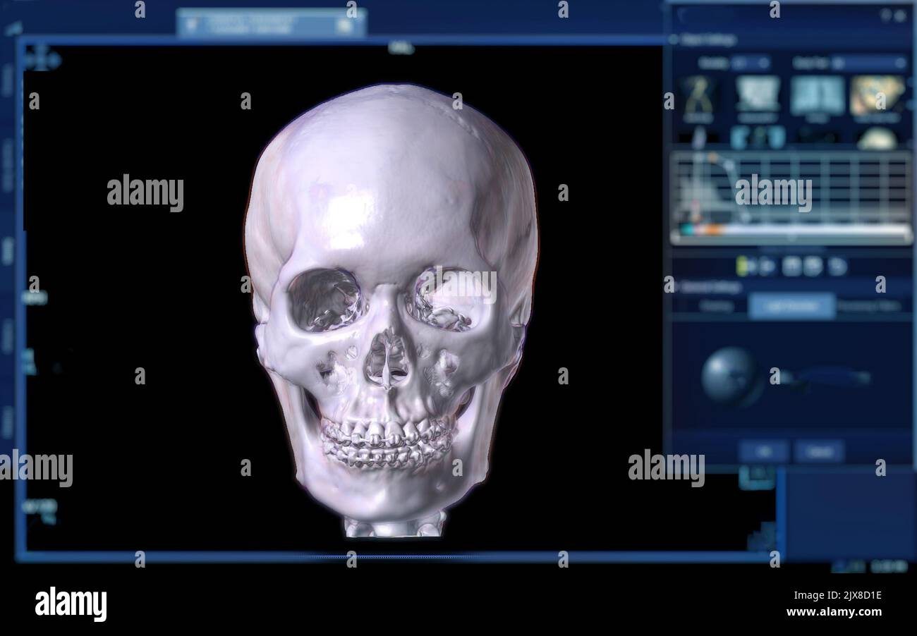 Acquisition CT du rendu de l'os facial 3D sur l'écran montrant le rendu du crâne humain 3D. Banque D'Images