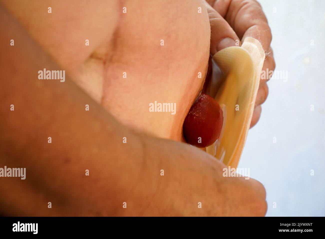 un homme met un sac d'ostomie Banque D'Images