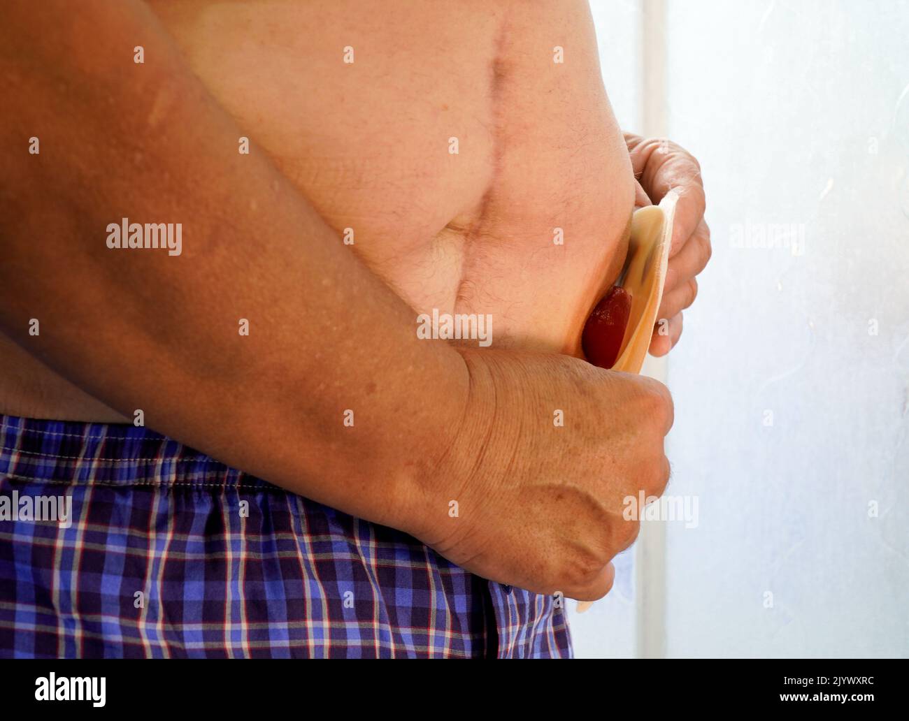 un homme met un sac d'ostomie. Banque D'Images