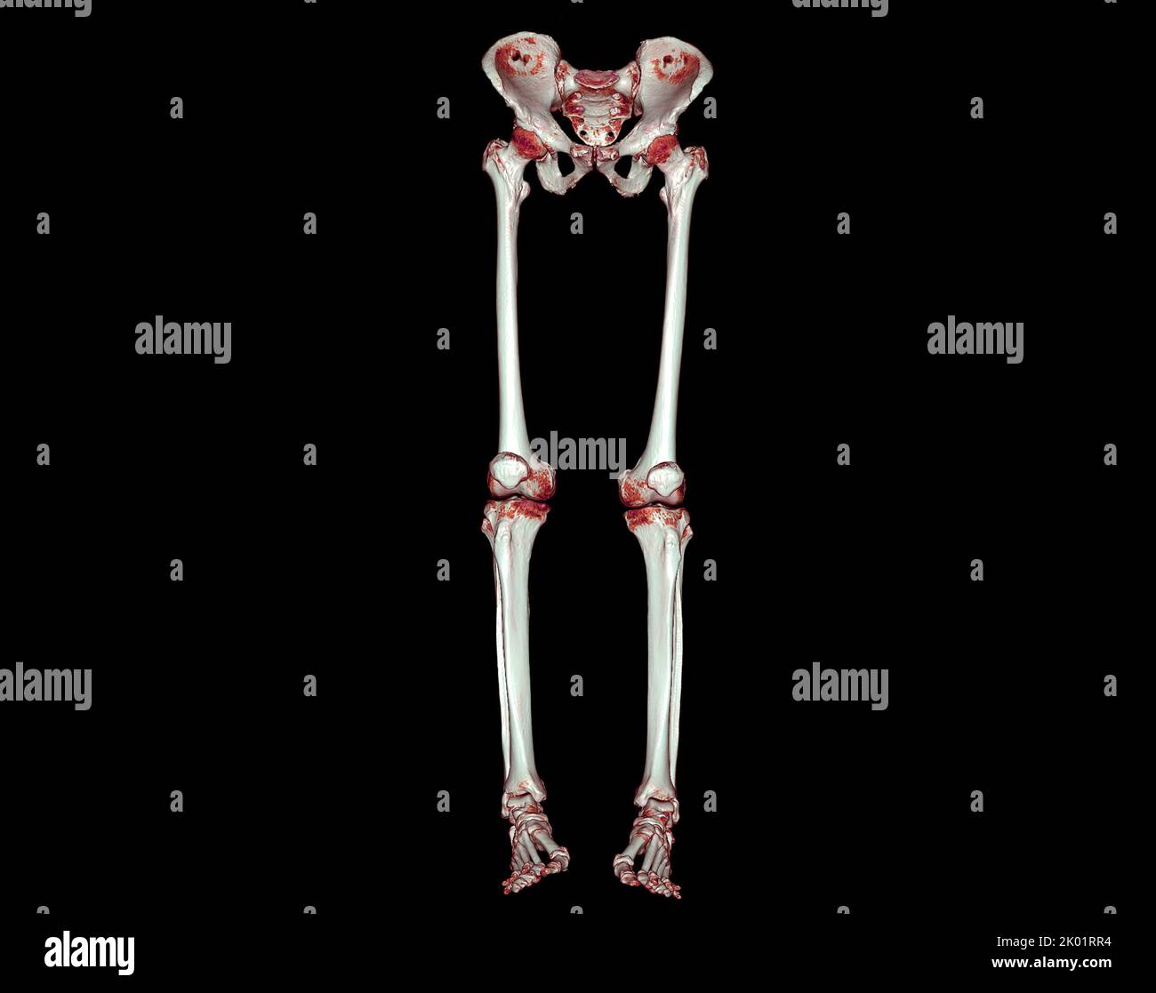 Acquisition CT de l'extrémité inférieure 3D pour le diagnostic de fracture de l'os du fémur , de l'articulation du genou , de la jambe et du pied 3D rendu Banque D'Images