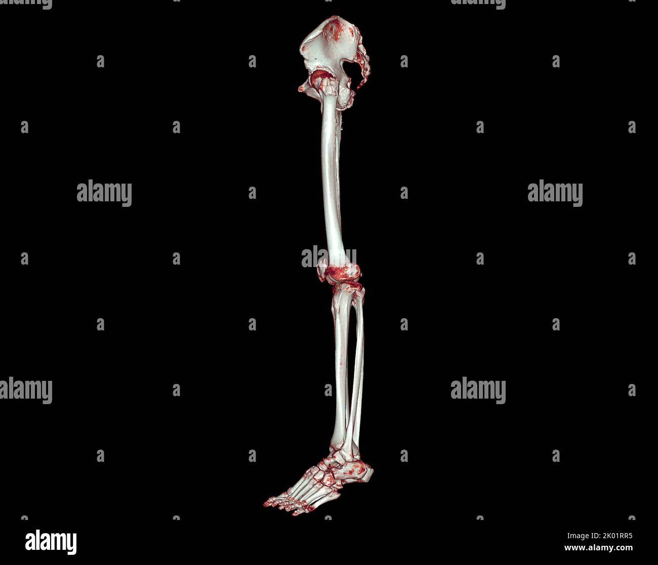 Acquisition CT de l'extrémité inférieure 3D pour le diagnostic de fracture de l'os du fémur , de l'articulation du genou , de la jambe et du pied 3D rendu Banque D'Images