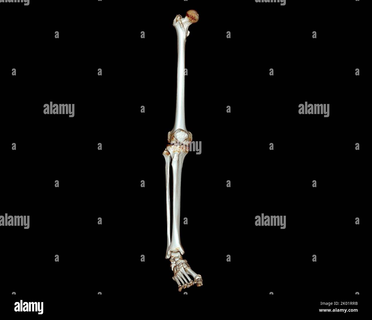 Acquisition CT de l'extrémité inférieure 3D pour le diagnostic de fracture de l'os du fémur , de l'articulation du genou , de la jambe et du pied 3D rendu Banque D'Images