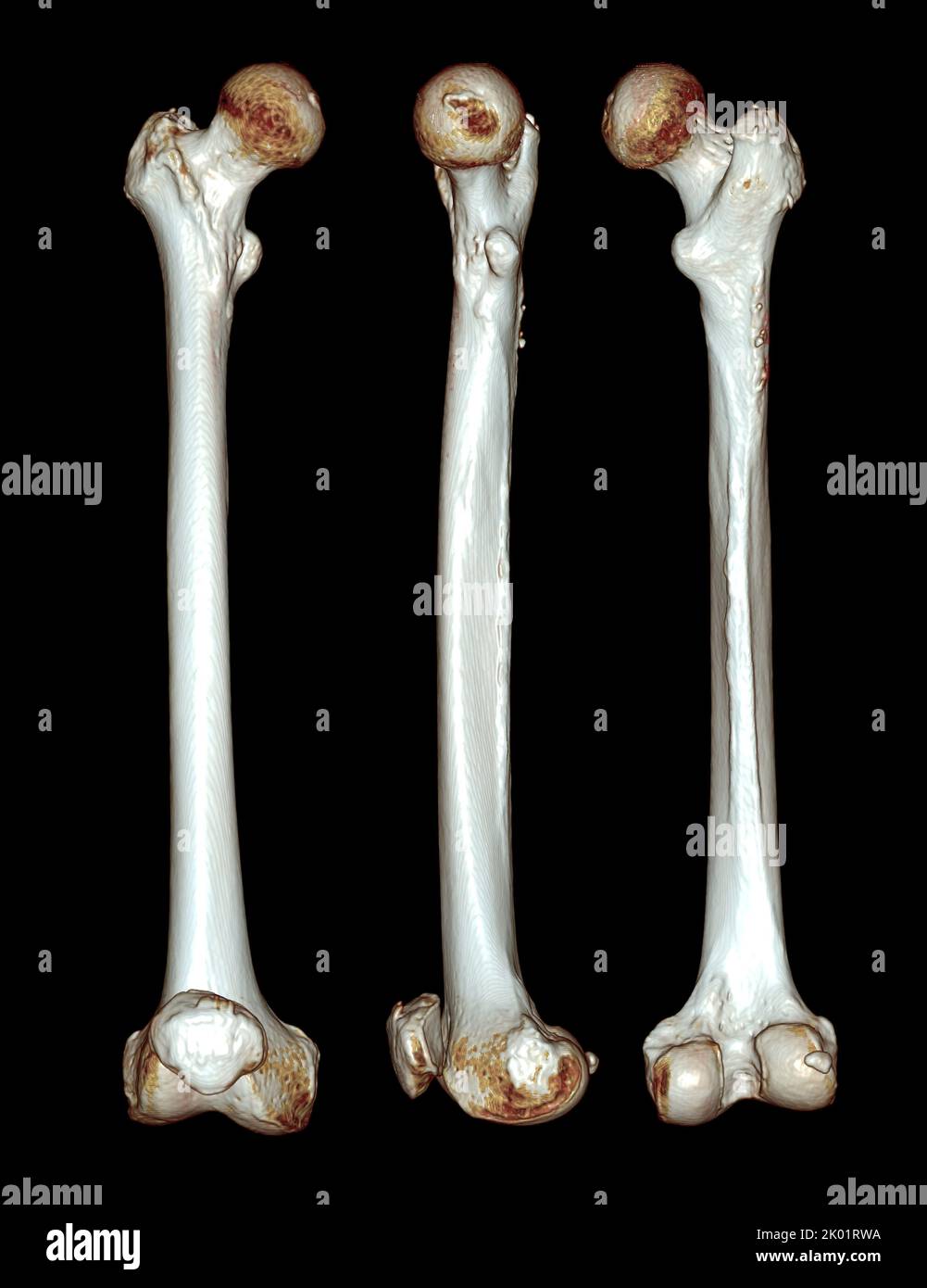 Acquisition CT de l'os du fémur et de l'os de la cuisse 3D pour le diagnostic de fracture de l'os du fémur isolé sur fond noir. Masque. Banque D'Images