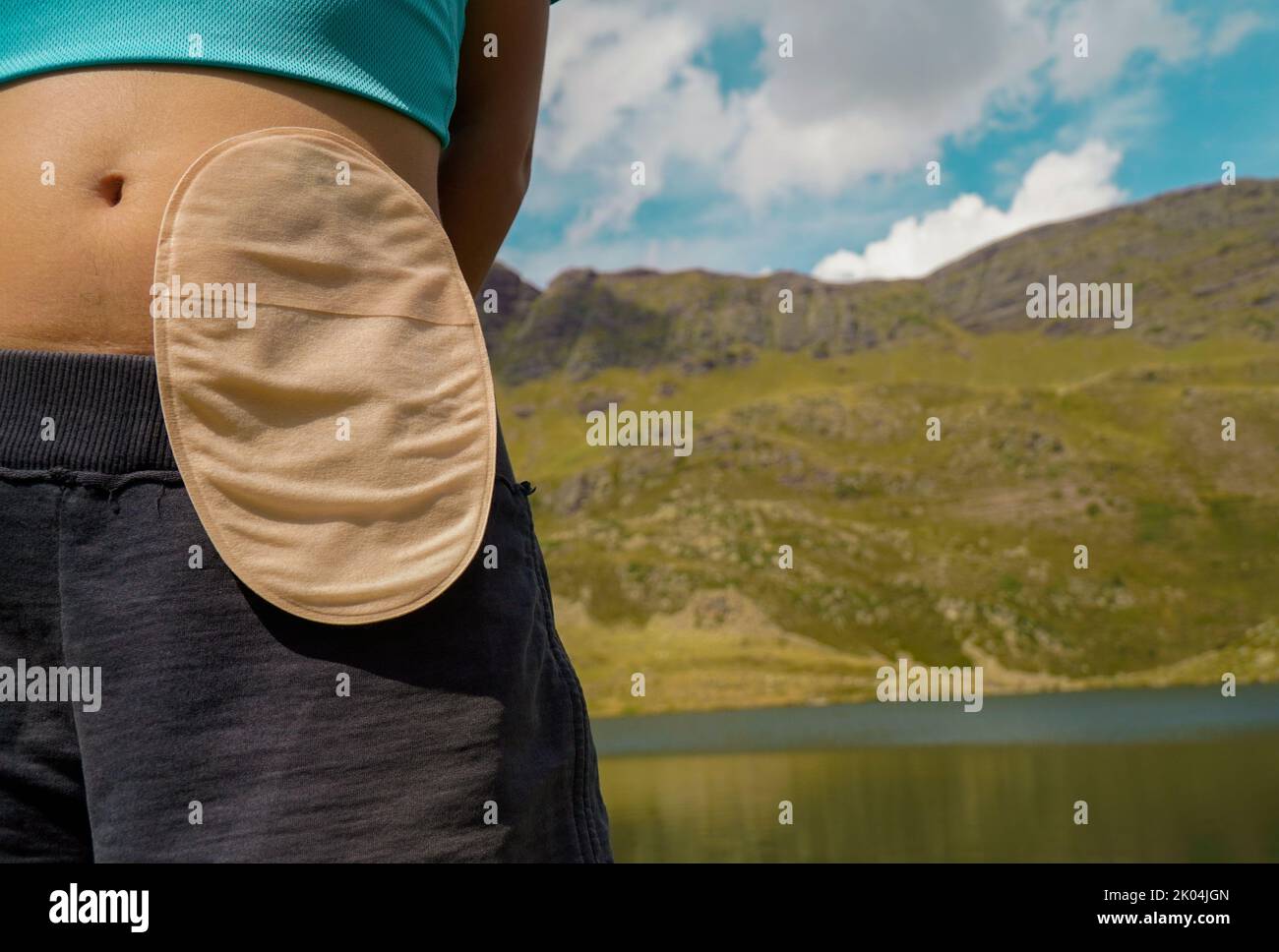 Femme avec sac de colostomie dans les montagnes. Banque D'Images